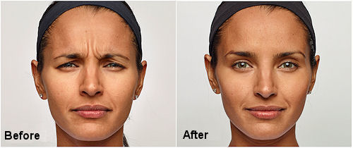 Dysport Skin Treatment