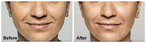 Restylane Lyft
