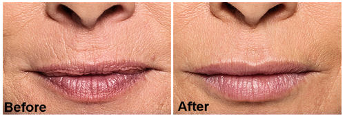 Restylane Silk