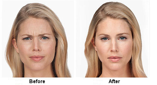 Botox Before and After