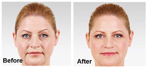 Juvederm XC